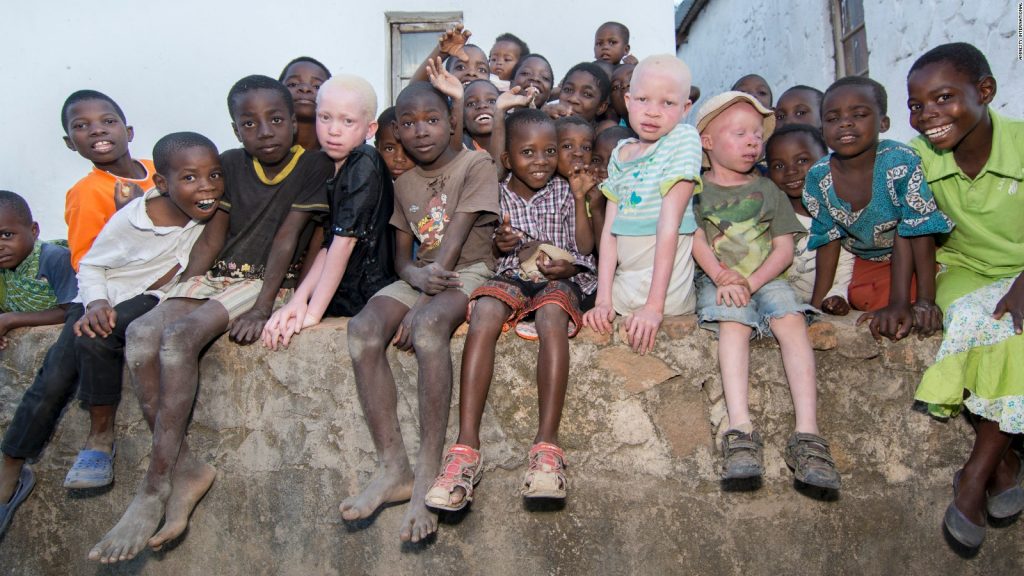 Pembantaian Albino di Afrika Demi Praktik Ilmu Hitam